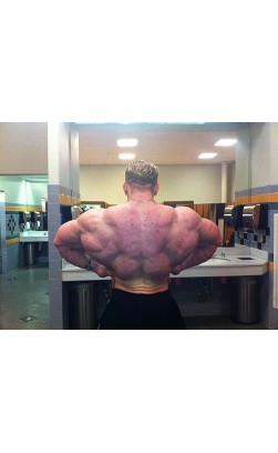 Steroids, Hair Loss and Acne